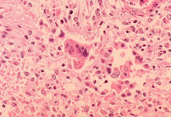 Histopathology of measles pneumonia. Giant cell with intracytoplasmic inclusions. CDC image / Dr. Edwin P. Ewing, Jr.