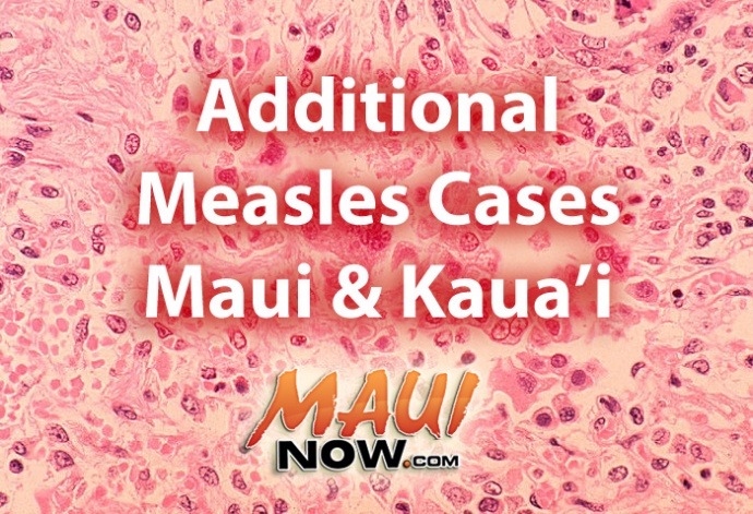 Additional measles cases confirmed on Maui & Kauaʻi.  Background image: Histopathology of measles pneumonia. Giant cell with intracytoplasmic inclusions. CDC image / Dr. Edwin P. Ewing, Jr.